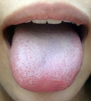 正常人的舌苔白色,薄而均匀的平铺在舌面,在舌面中部以及根部稍厚.