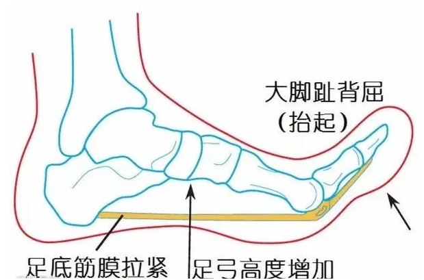 真正的炎症,而是由于反复的细微损伤,过度紧张引起足底筋膜的劳损和