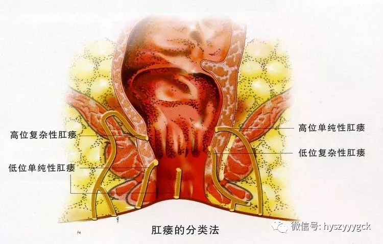 肛周脓肿肛瘘的诊治