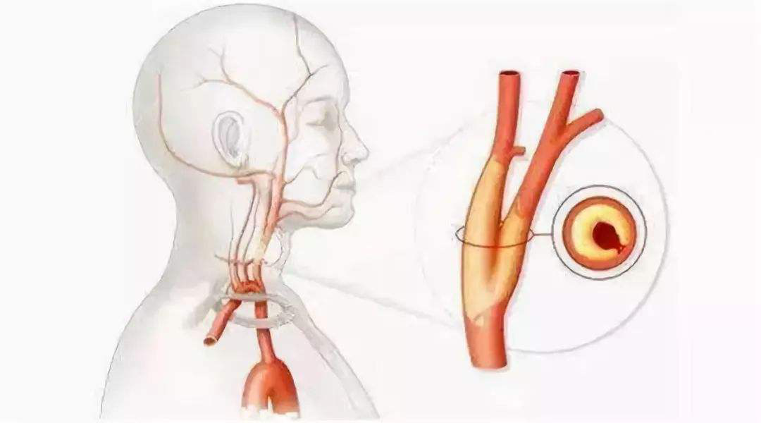 颈动脉狭窄80%做颈动脉剥离手术成功率多高