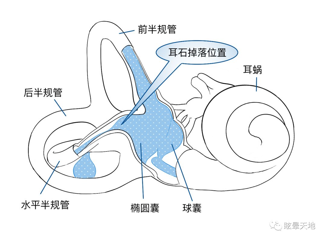 耳石脱落后,游离在内耳淋巴液中,当人体头位发生变化时,耳石随重力