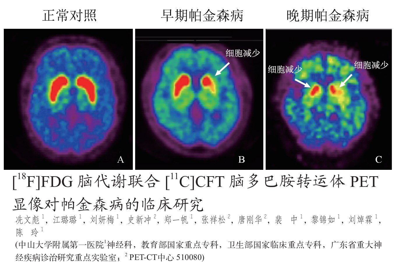 脑pet扫描诊断帕金森病最准确的检查