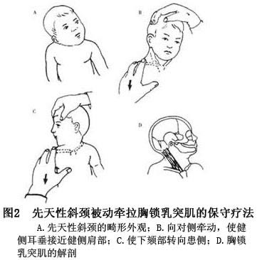 先天性肌性斜颈与婴儿扁头