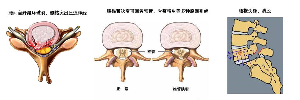 能够切除大部分类型的突出的椎间盘,对于椎间孔狭窄和部分侧隐窝狭窄