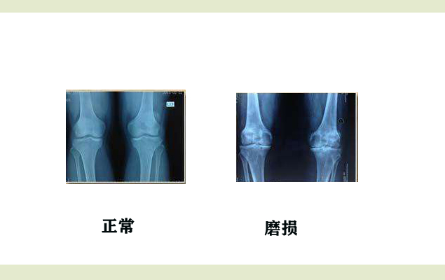 为什么膝产节拨针松解术小针刀松解臭氧治疗膝关节退行性骨关节效果好