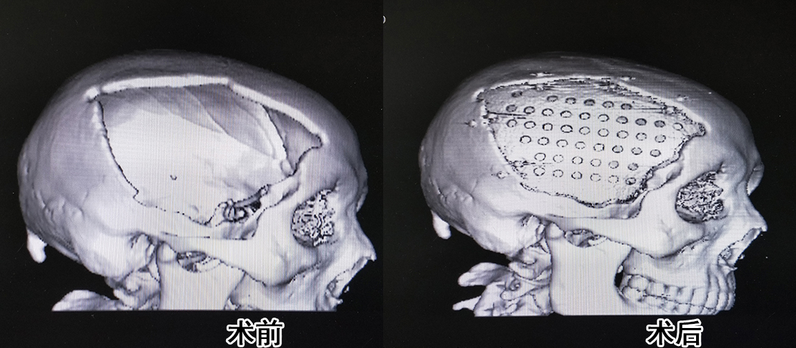 而且穆苍山主任还成功开展了peek颅骨修复整形术,术后的效果更加地