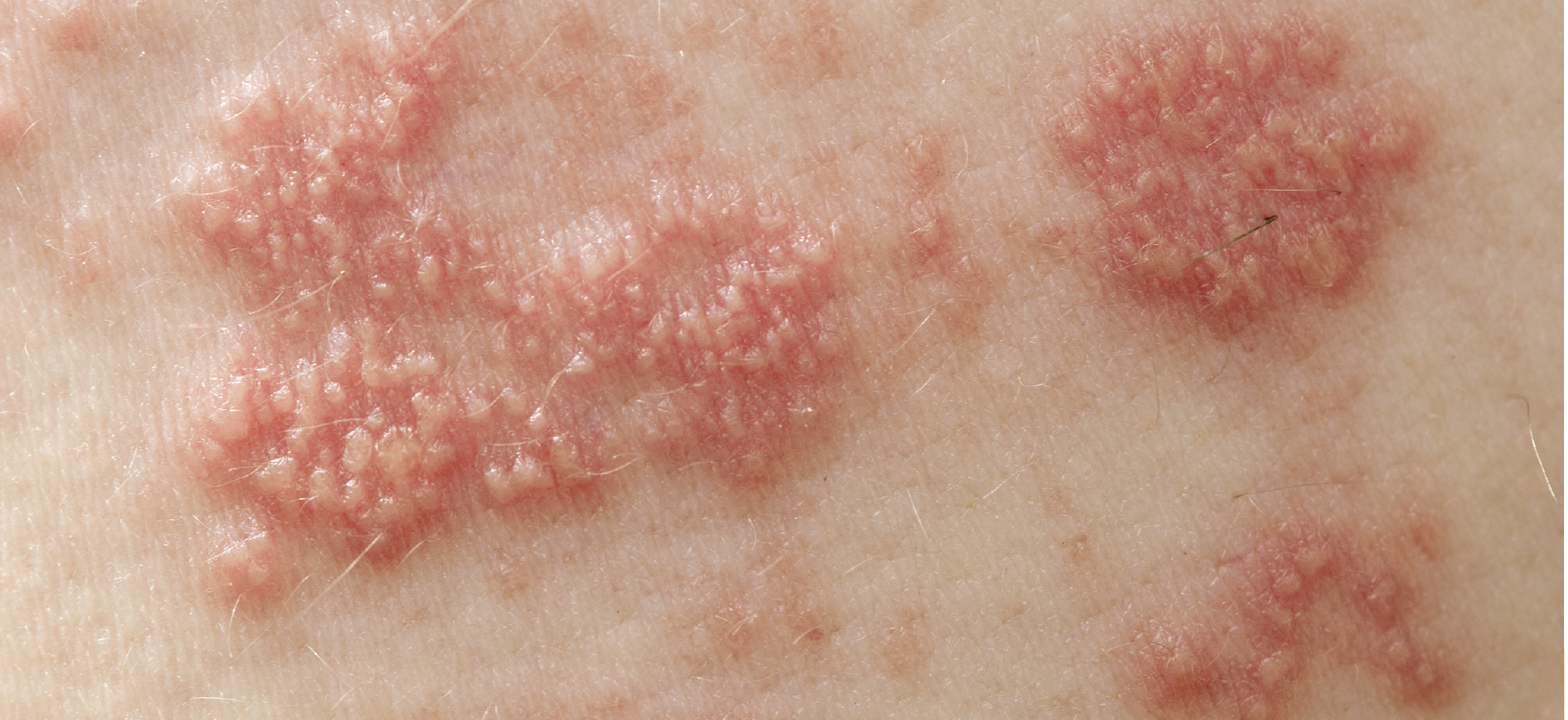 经历过带状疱疹有多痛后,你或许才意识到预防的重要性