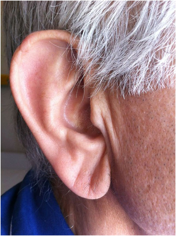 耳垂有褶皱,可能是这种病的征兆