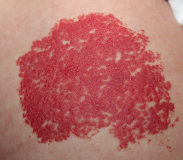 皮肤红色血管瘤图片图片
