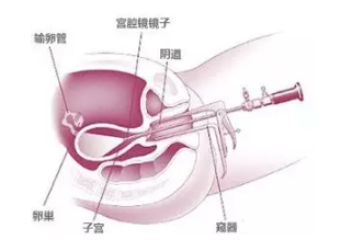 输卵管插管图片