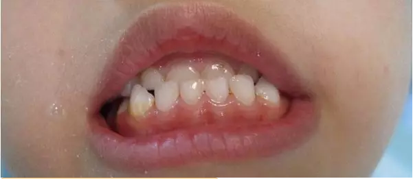 儿童牙齿咬合标准图片图片