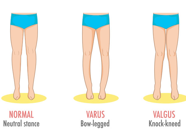 o型腿形成的原因有很多,比如膝关节外侧副韧带松弛,骨软骨发育不良等