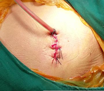 自发性气胸科普