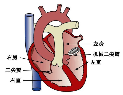 风湿性心脏病二尖瓣置换主动脉瓣置换术也能微创