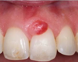 牙龈癌初期图片图片
