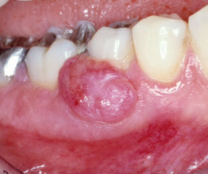 牙龈癌初期图片图片