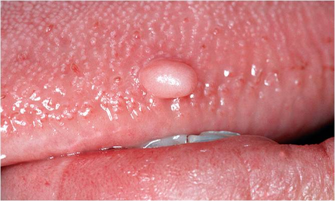 舌纤维瘤图片图片