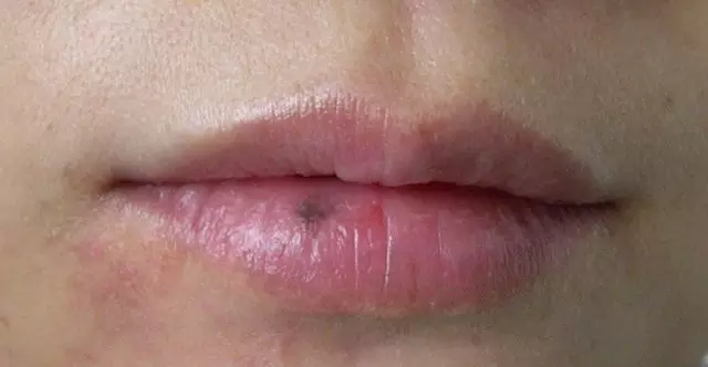 口唇多发性黑斑,特别是口周比较明显,首先考虑色素沉着