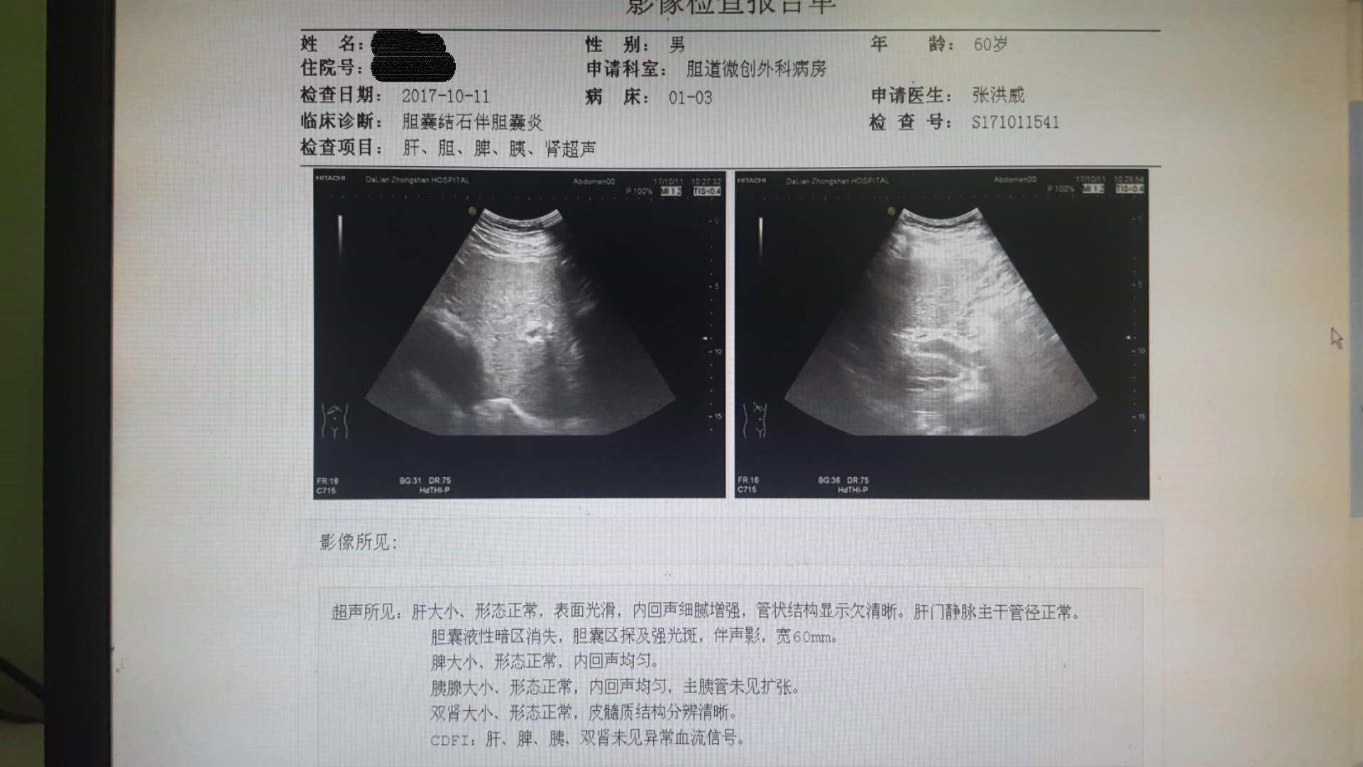 一例充满型胆囊结石的保胆治疗