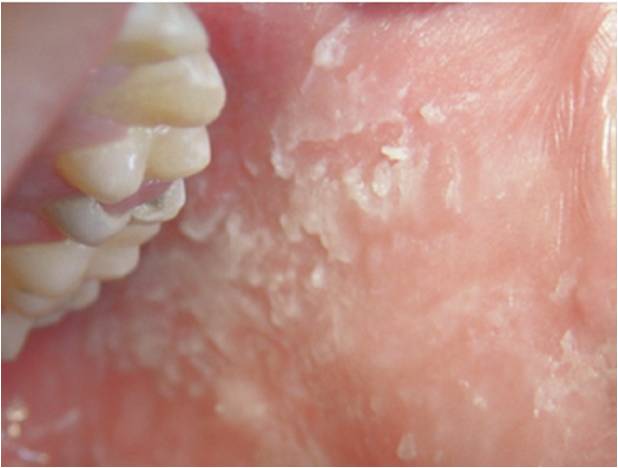 口腔黏膜白色海绵状斑痣