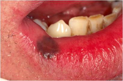 常见于唇,牙龈,腭,颊,舌等黏膜