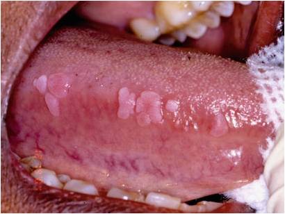 口腔粘膜结节状图片图片