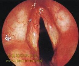 慢性喉炎1.jpg