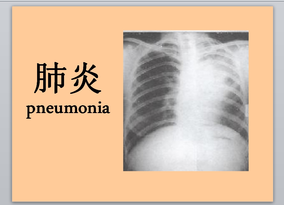 肺炎图片大全图片