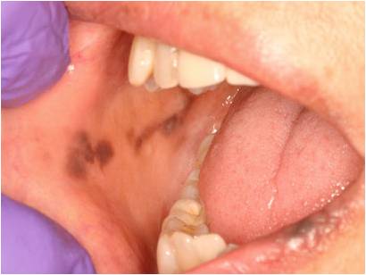 黏膜咬伤,牙周炎,扁平苔癣,红斑狼疮,化妆品等可导致黏膜色素沉着,沉