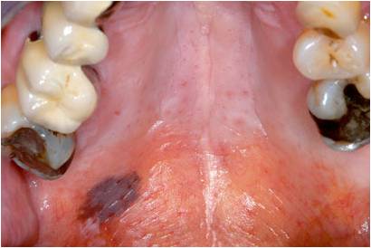 口腔黏膜柯氏斑图片