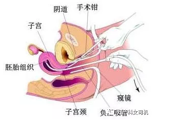 做过人流的子宫图图片