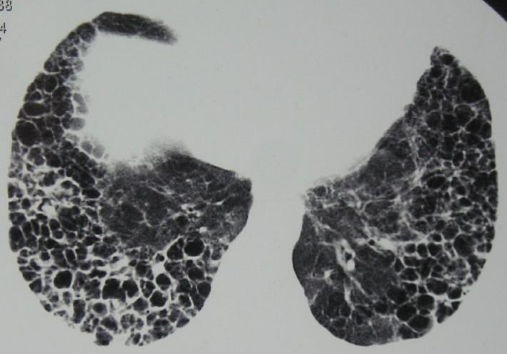 韦格纳肉芽肿肺部影像图片
