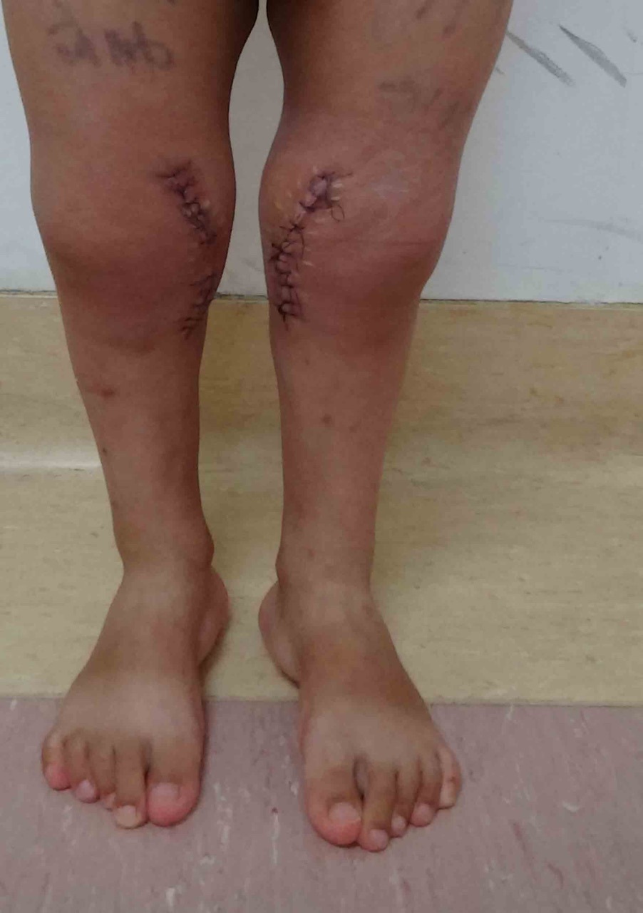 膝外翻畸形的手术治疗