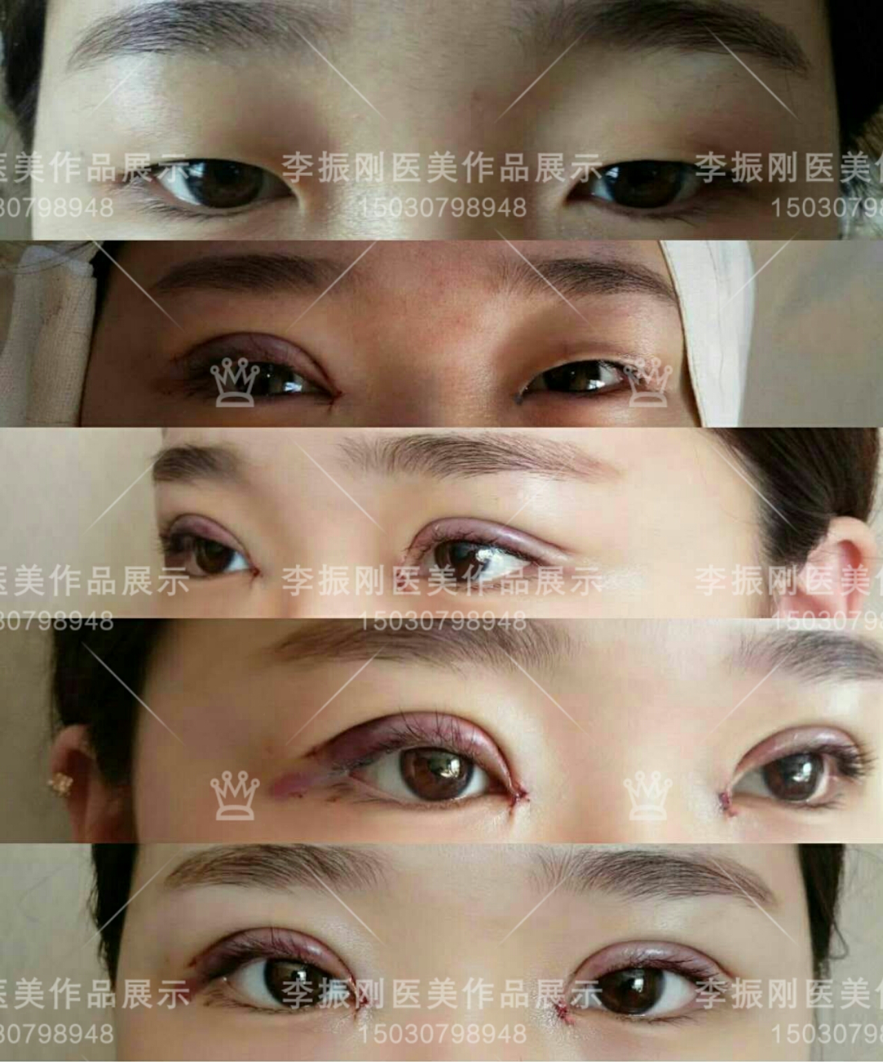 双眼破案例