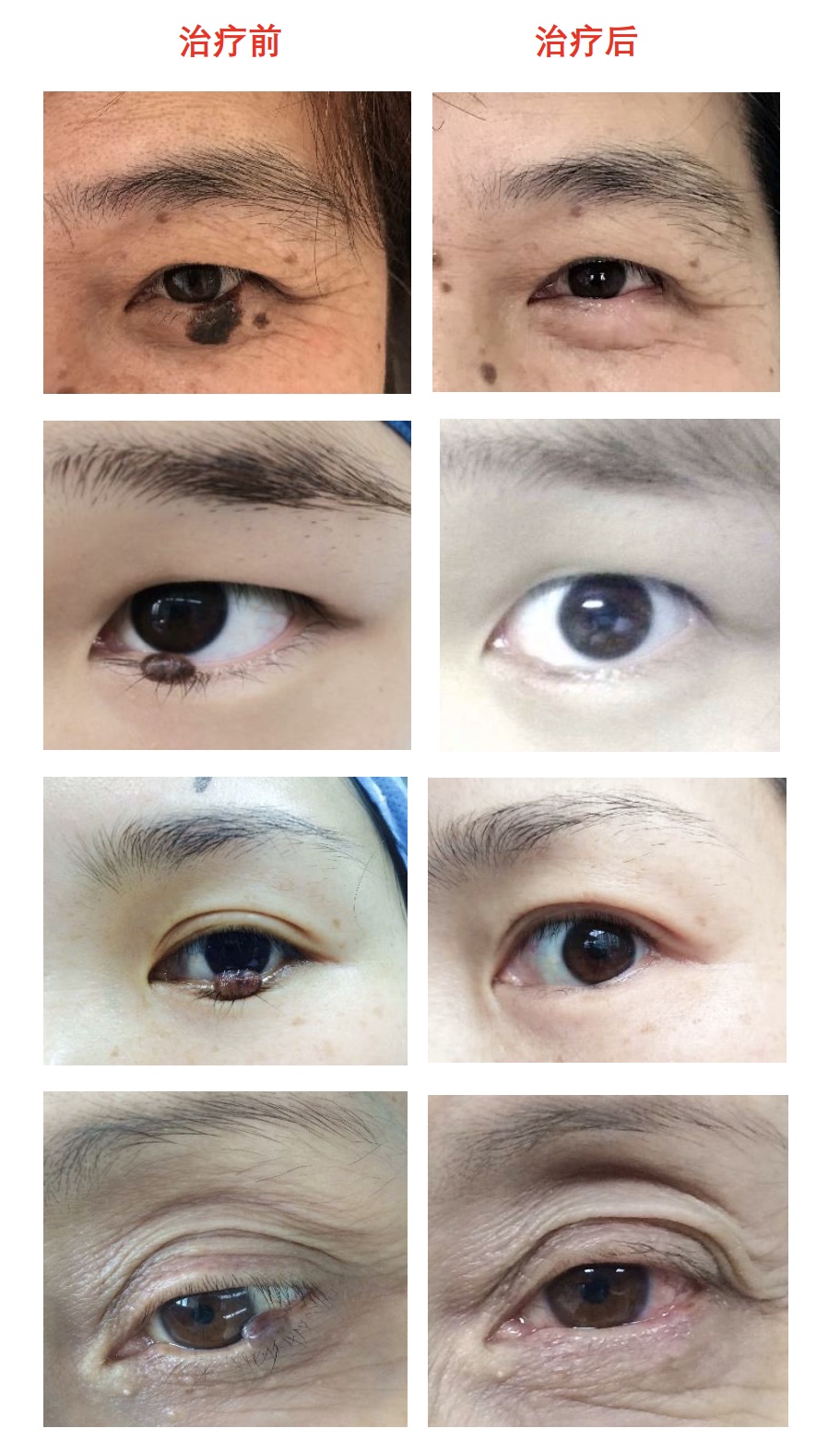 眼皮上长痣怎么办