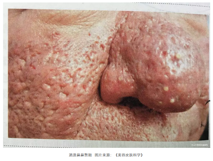 艾滋病鼻子症状图片图片