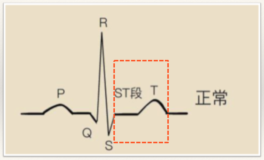st-t改变心电图图片