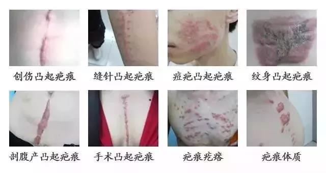 什么是增生性疤痕 2018_12_17_50b54b78d82ba4b5ccb0841388828004.jpg