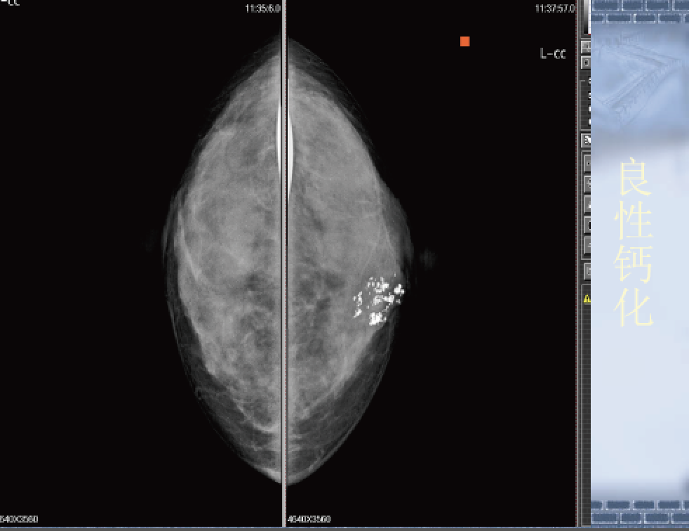 乳腺钼靶中央区位置图图片