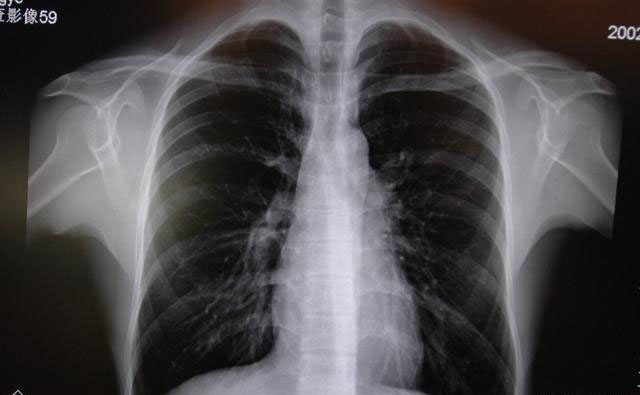 肺纹理增粗可能是肺癌吗?体检报告中纹理增粗代表什么,要治疗吗