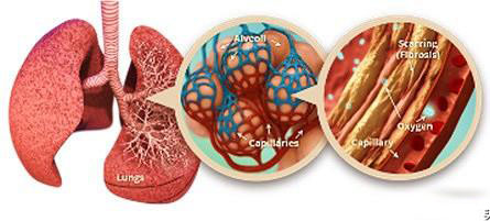肺纖維化最重要症狀就是缺氧最終病人憋氣難受氧療是唯一辦法