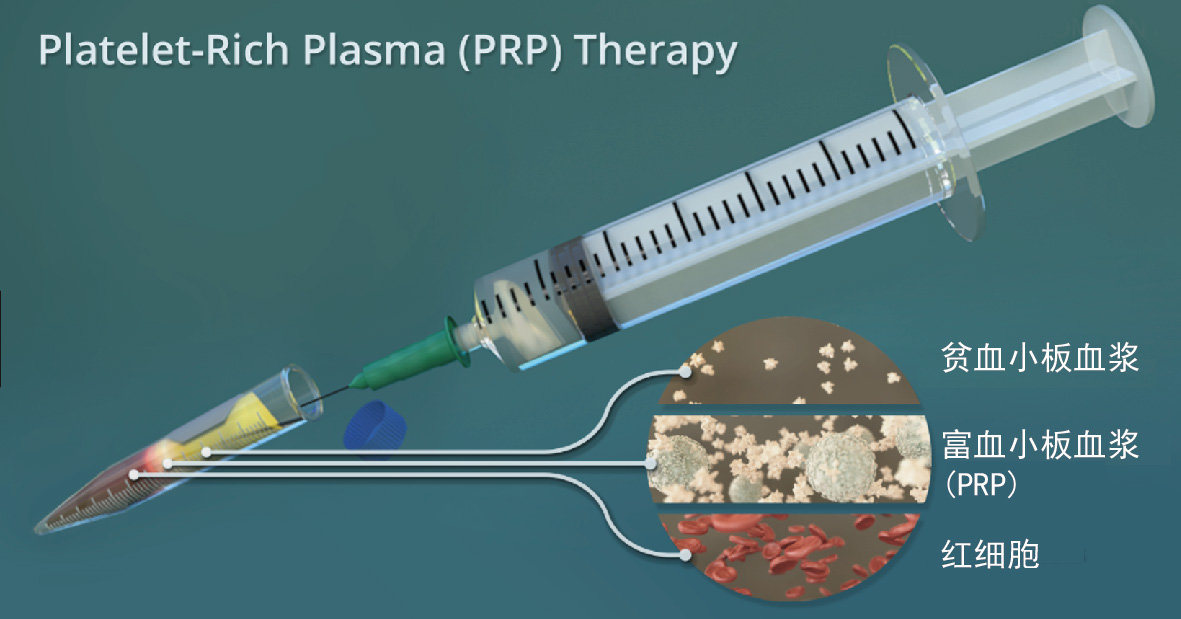 微针技术导入prp治疗痤疮瘢痕痘坑