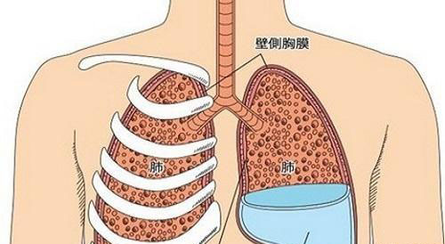 肺积水是怎么引起的图片