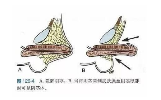 阴茎增大阿拉伯挤奶法和负压吸引仪有效果吗?