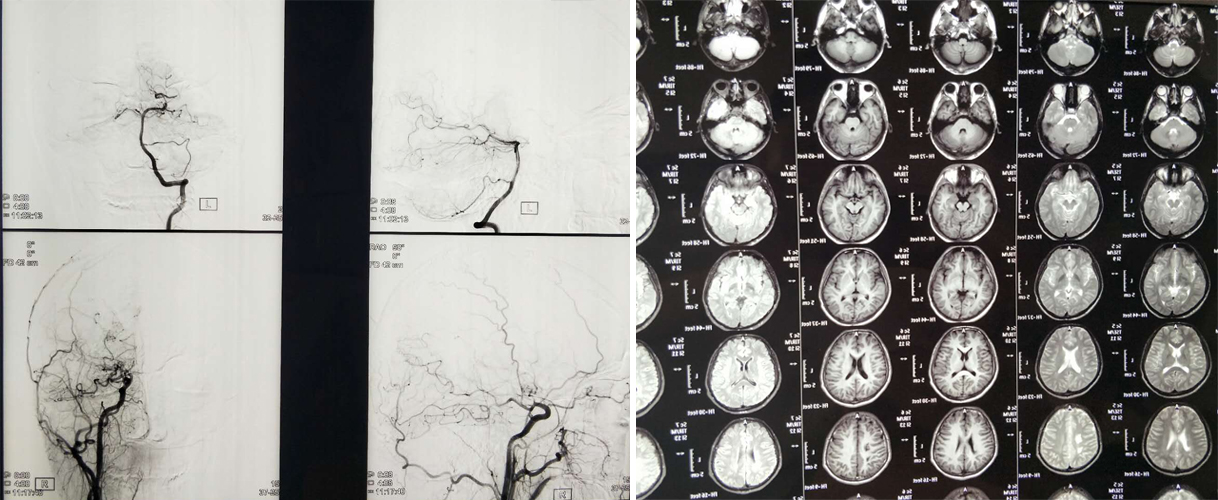 患者腦血管造影和ct檢查影像