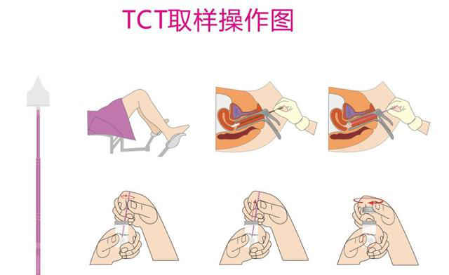 tct取样的过程图图片