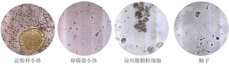 卵磷脂小体正常图片