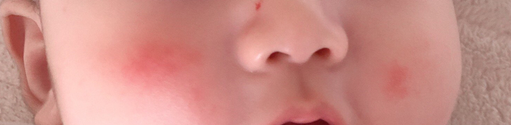 1新生儿红斑1.jpg