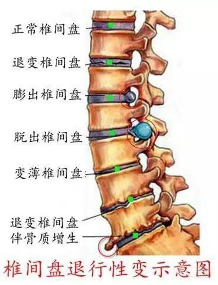 腰椎间盘突出