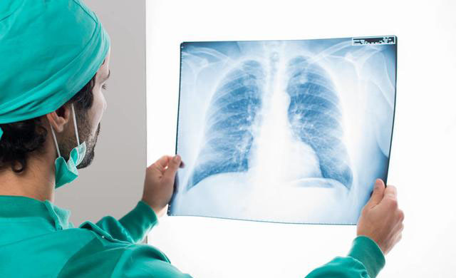 肺鳞癌中晚期能活20年吗肺科专家告诉你答案其实不需要纠结
